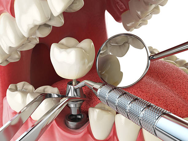 Best Knocked-Out Tooth (Avulsed Tooth) Treatment in Edgewood, TX